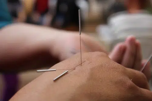 Séances d’acupuncture : quels bienfaits pour l’organisme ?