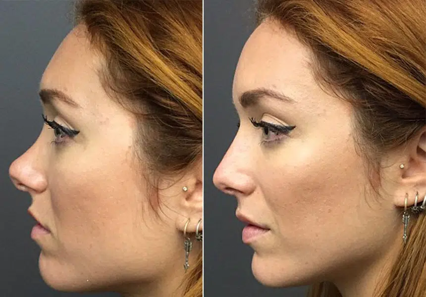 Rhinoplastie : les risques encourus